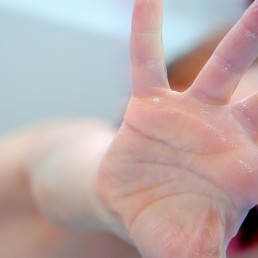 hand showing eczema